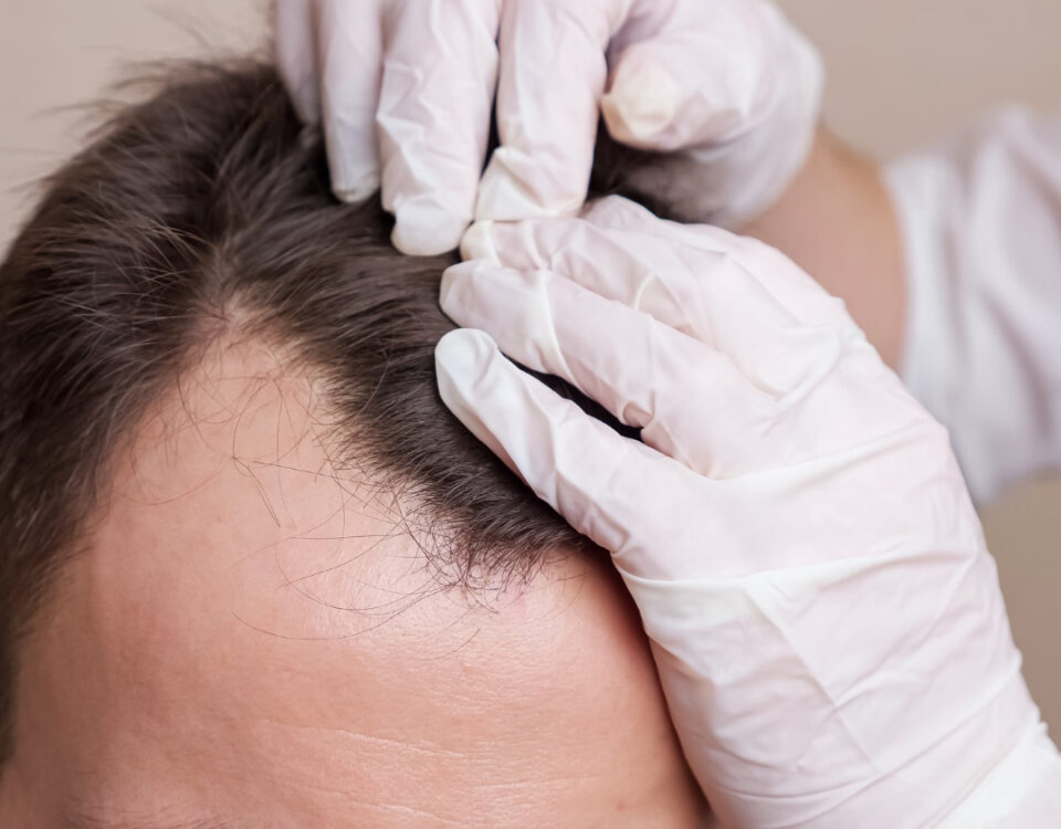 Quais são os direitos do paciente em um transplante capilar? Quais são os direitos do paciente em um transplante capilar?